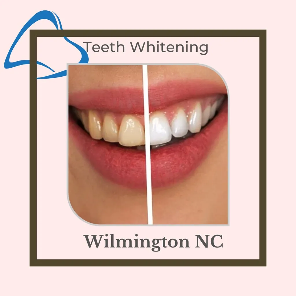 30656 over the counter whitening