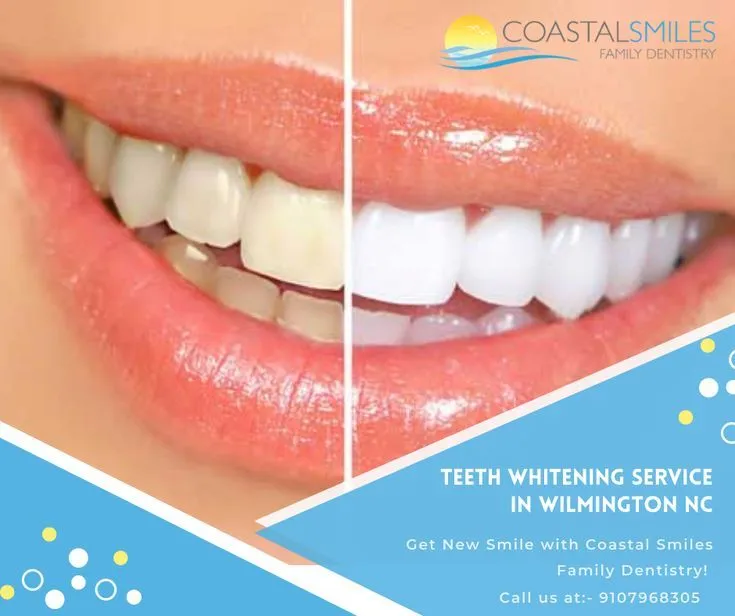 30656 teeth whitening treatment