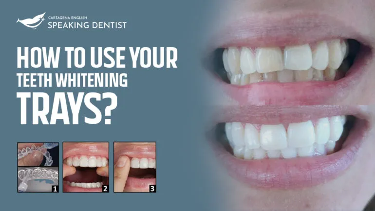 30664 pre filled teeth whitening trays