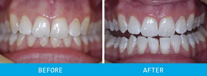 30664 teeth whitening results