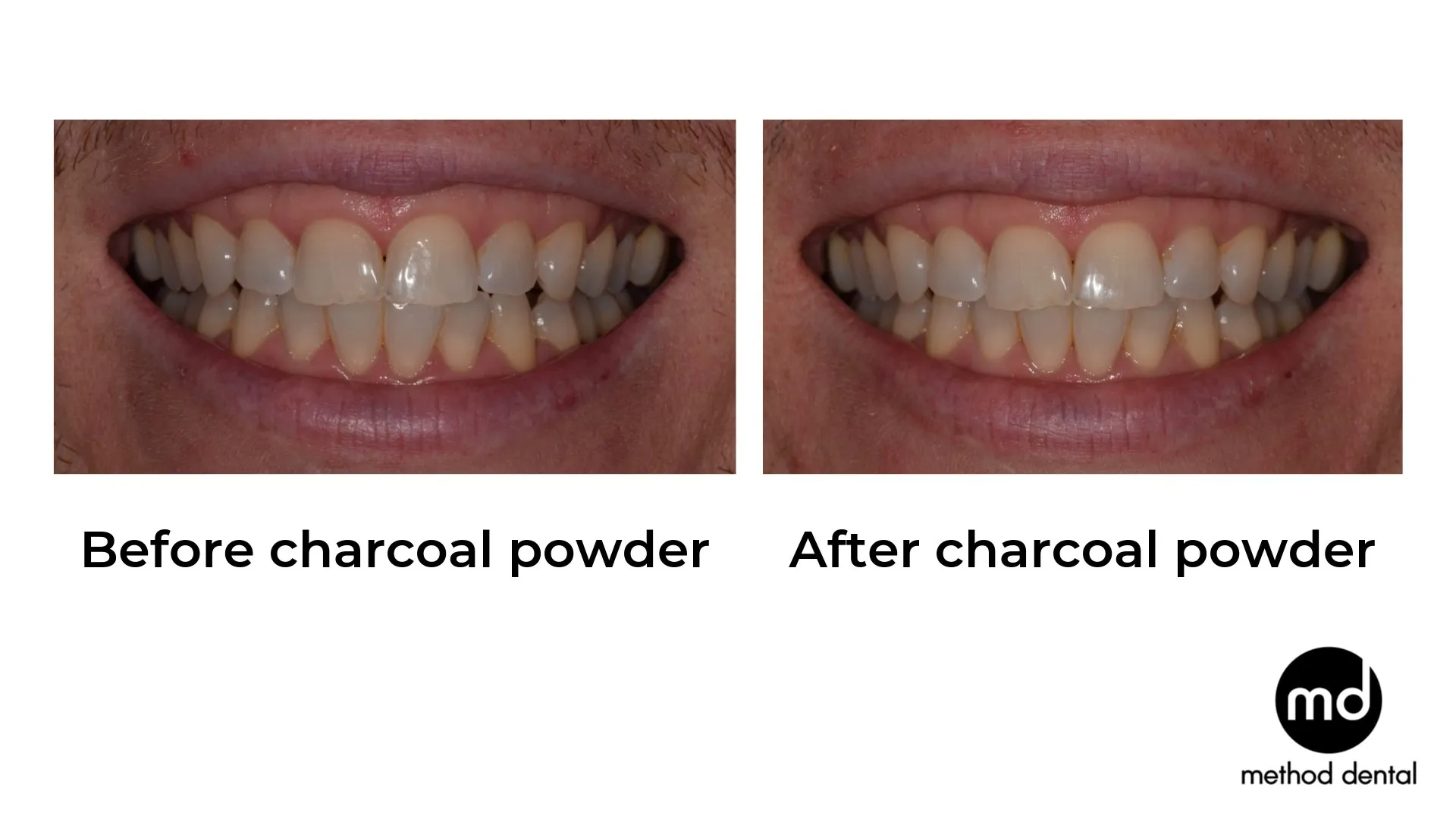 30679 charcoal teeth whitening rinse