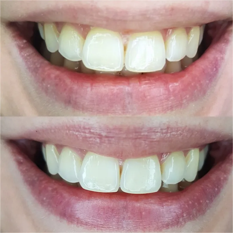 30679 charcoal whitening expected results