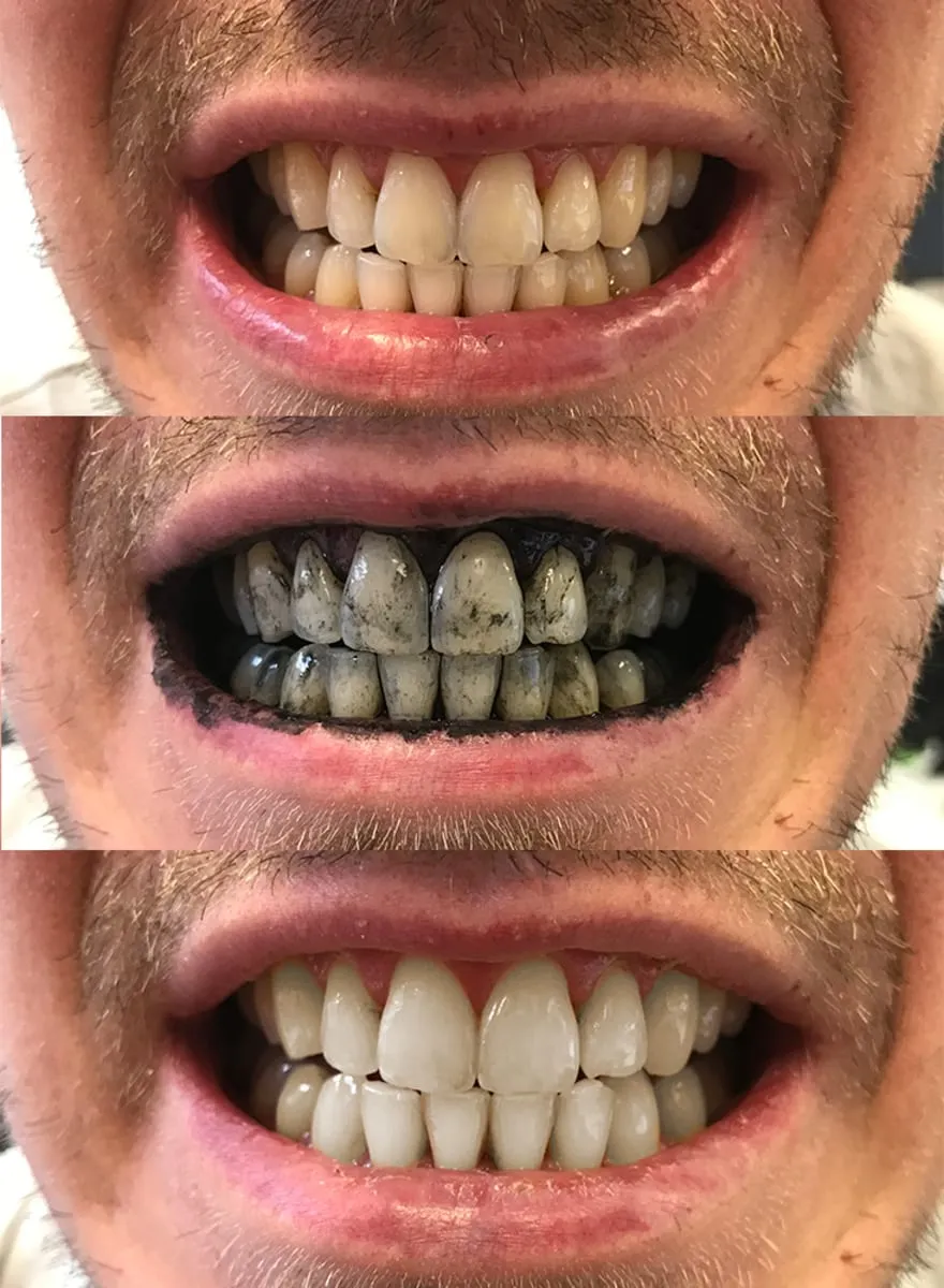 30679 teeth whitening maintenance