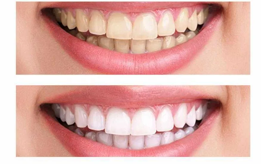 30680 affordable teeth whitening