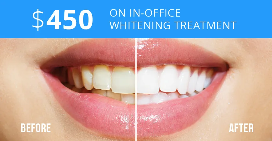 30680 teeth whitening at dentist