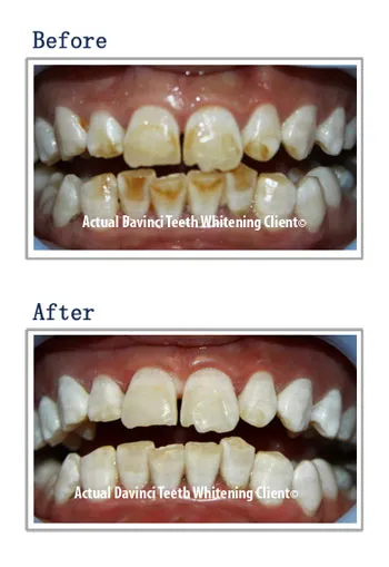 30681 at home teeth whitening