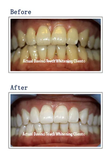 30681 teeth whitening benefits