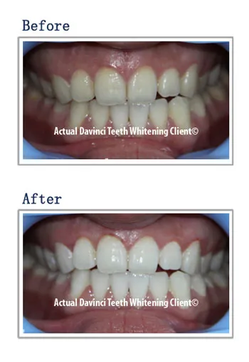 30681 teeth whitening process
