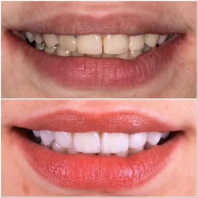 30683 at home teeth whitening