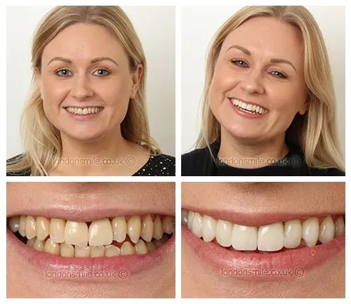 30683 london teeth whitening