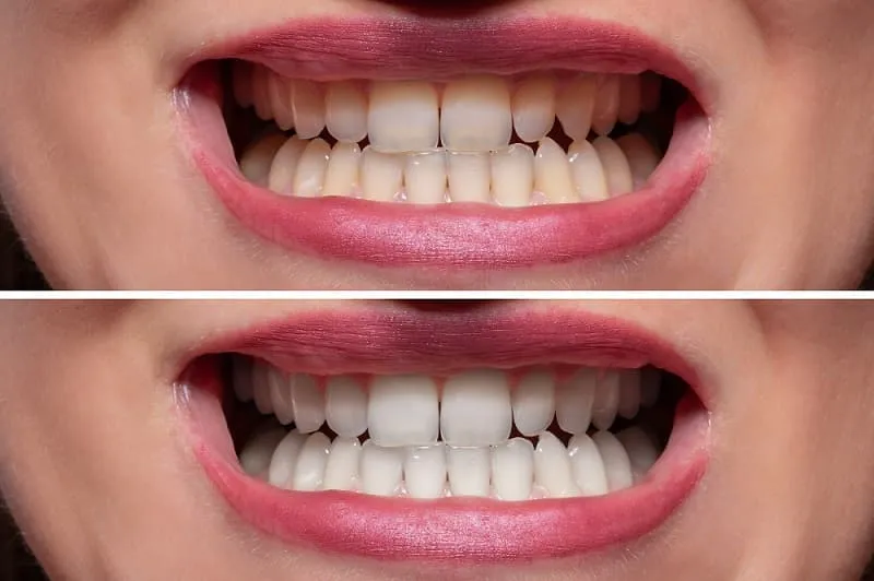 30683 teeth whitening options