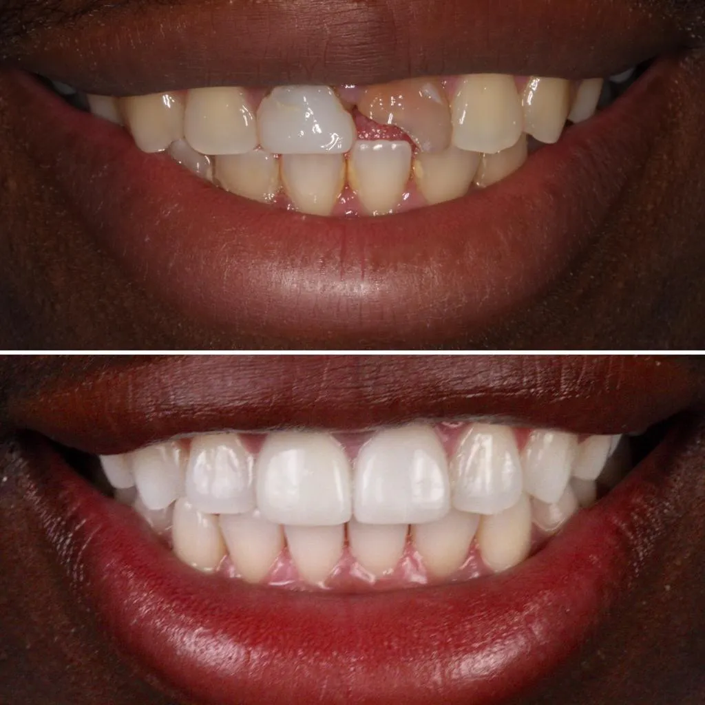 /img/30683-teeth-whitening-risks.webp