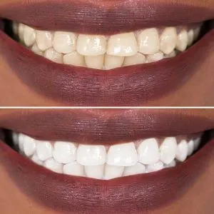 30684 healthy smile teeth whitening