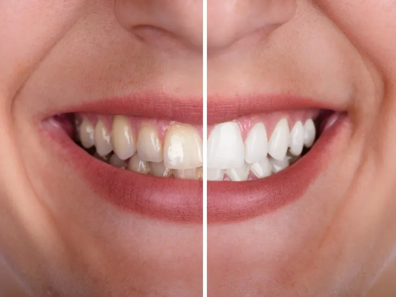 30684 teeth whitening cost michigan