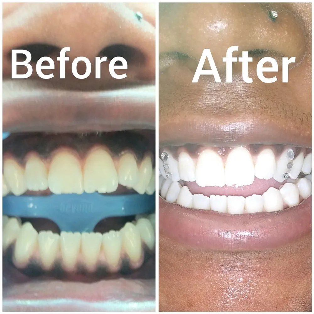 30684 teeth whitening image removal