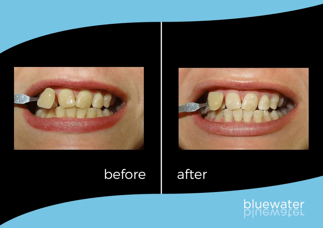 30699 zoom whitening sensitivity