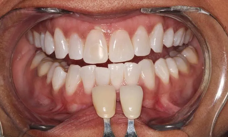 30703 humble house teeth whitening home remedies