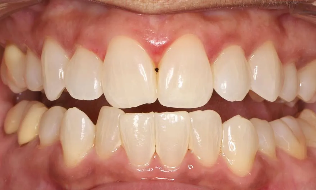 30703 humble house teeth whitening professional treatment