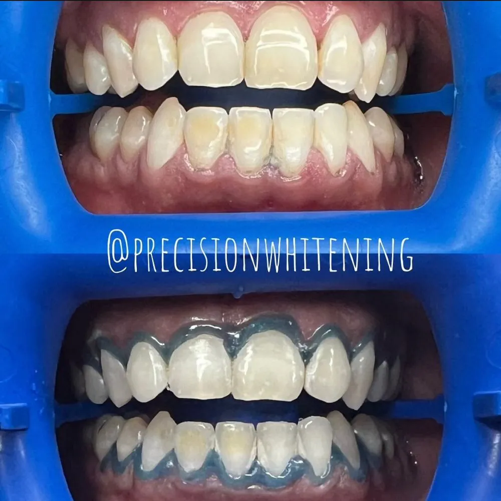 30703 teeth whitening humble house before after