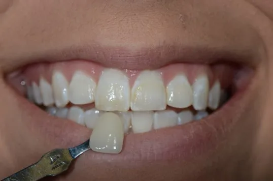 30704 at home teeth whitening