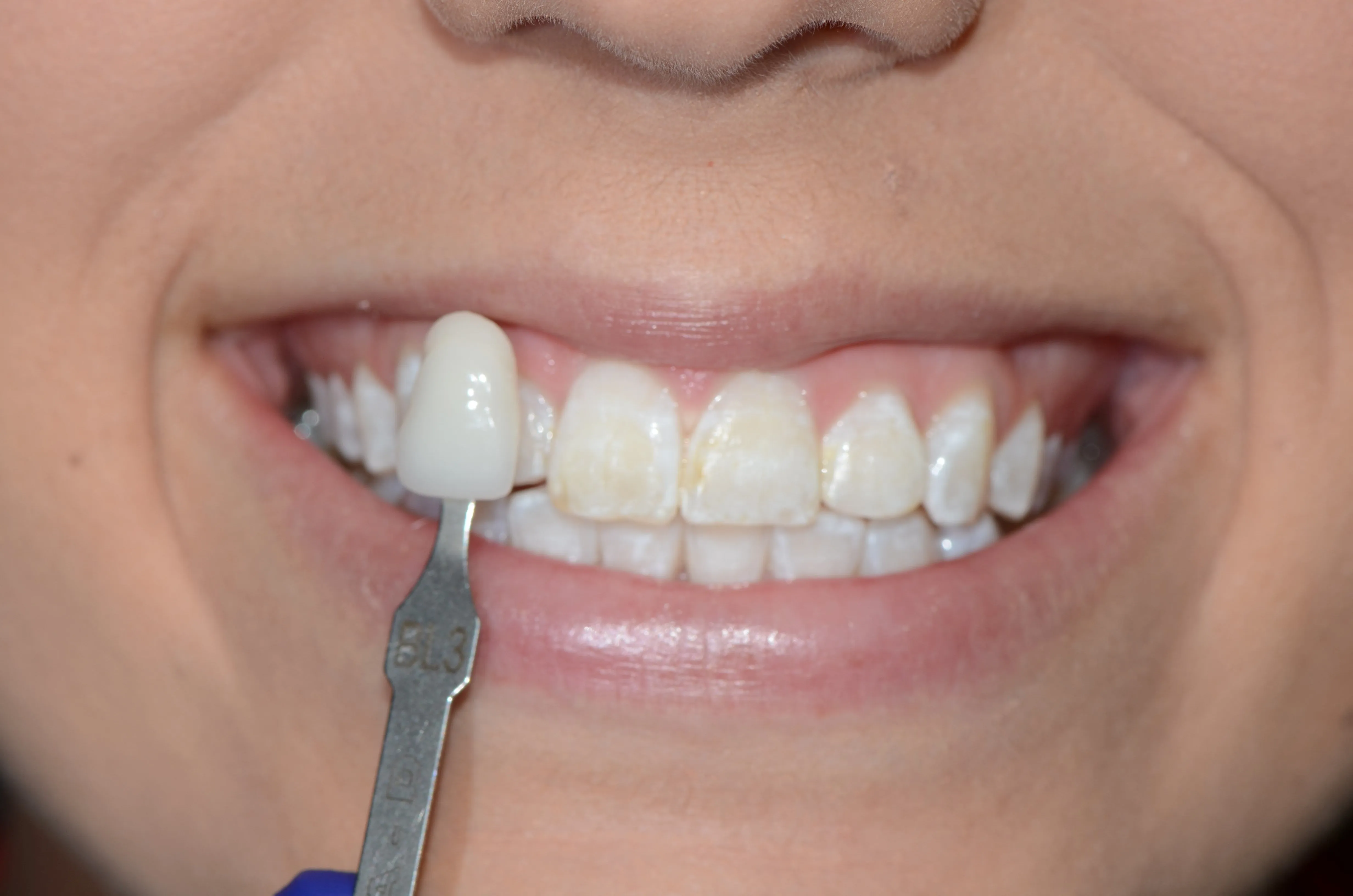 30704 professional teeth whitening