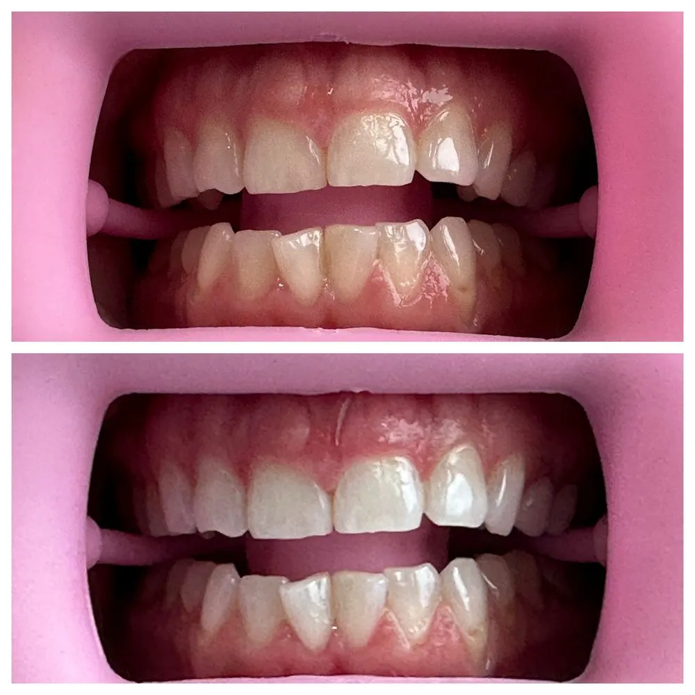 30704 teeth whitening options