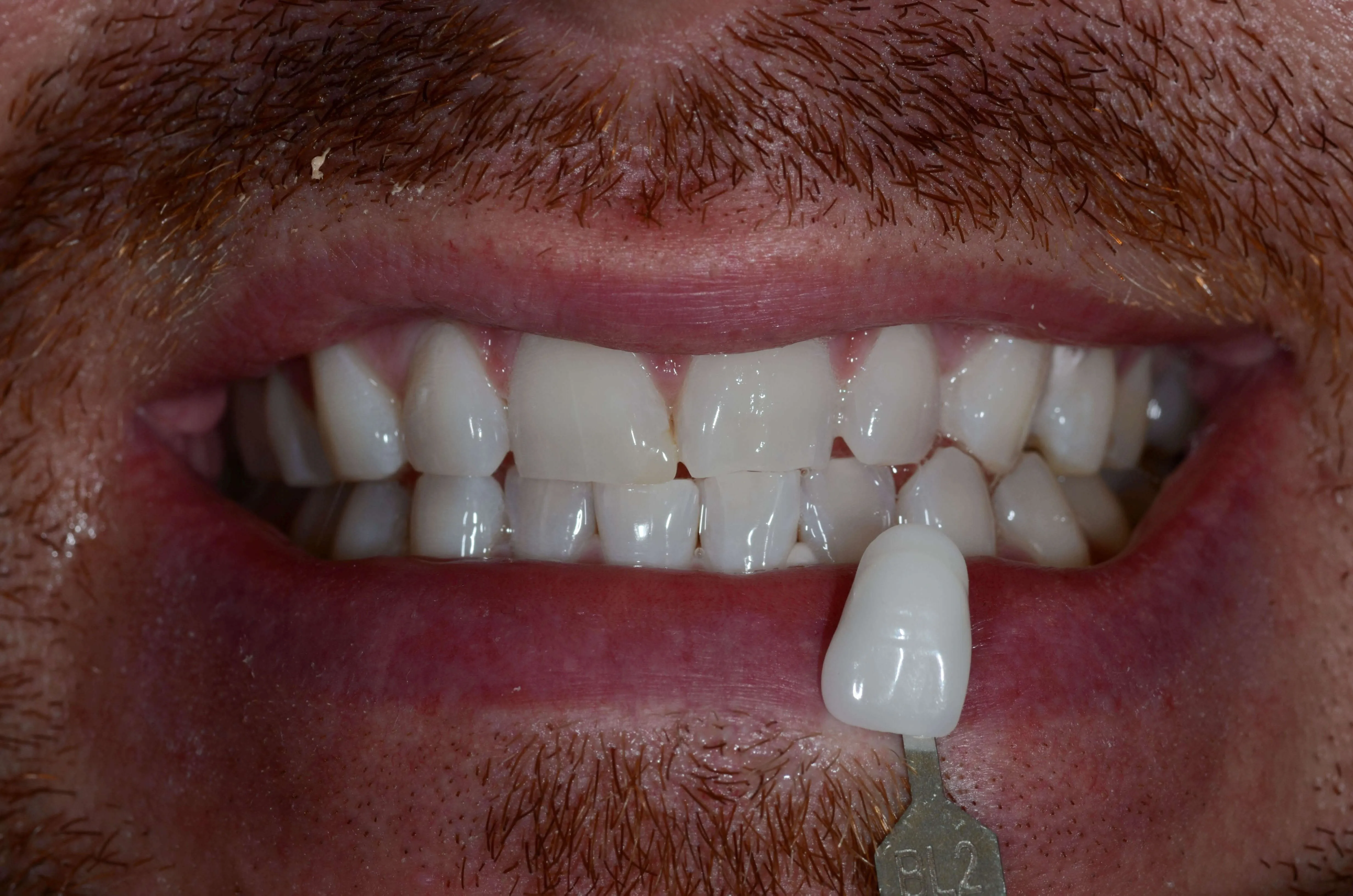 30704 teeth whitening woodlands