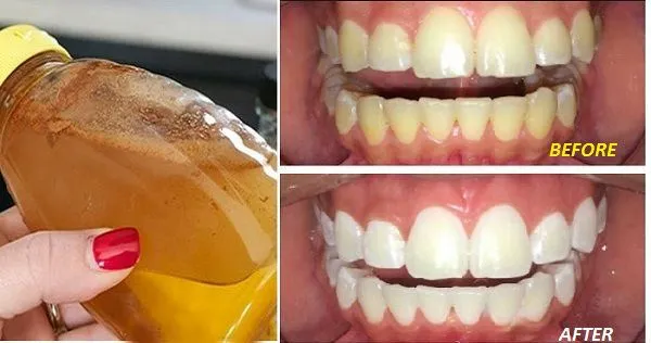 30717 acv teeth whitening image5