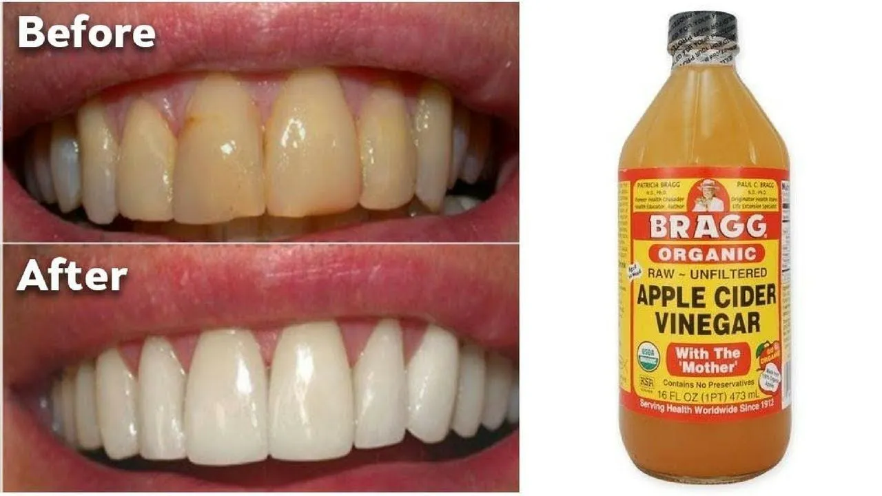 30717 acv teeth whitening image6