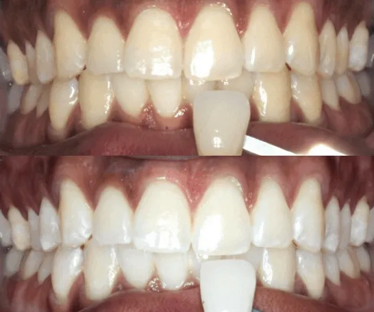 30722 in office teeth whitening
