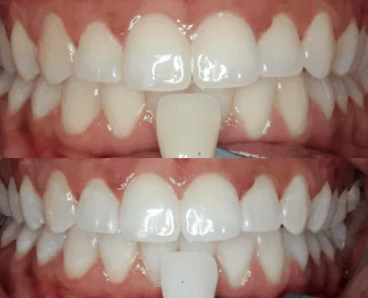 30722 oral hygiene routine