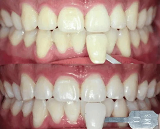 30722 professional teeth whitening