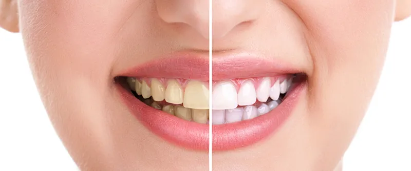 30728 at home teeth whitening kits