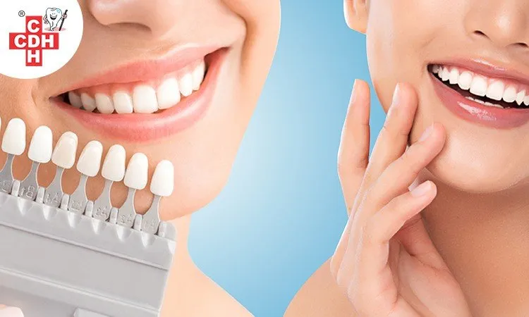 30728 teeth bleaching cons