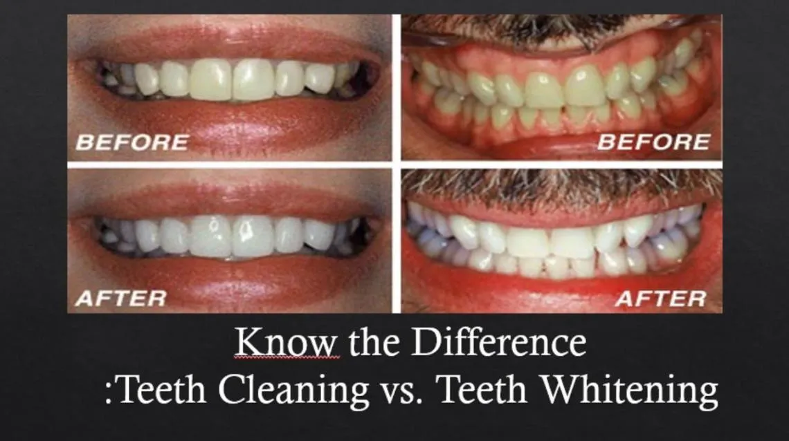 30728 teeth bleaching process