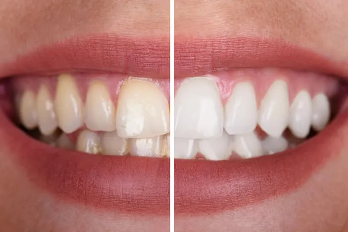 30729 at home teeth whitening kits tyler tx