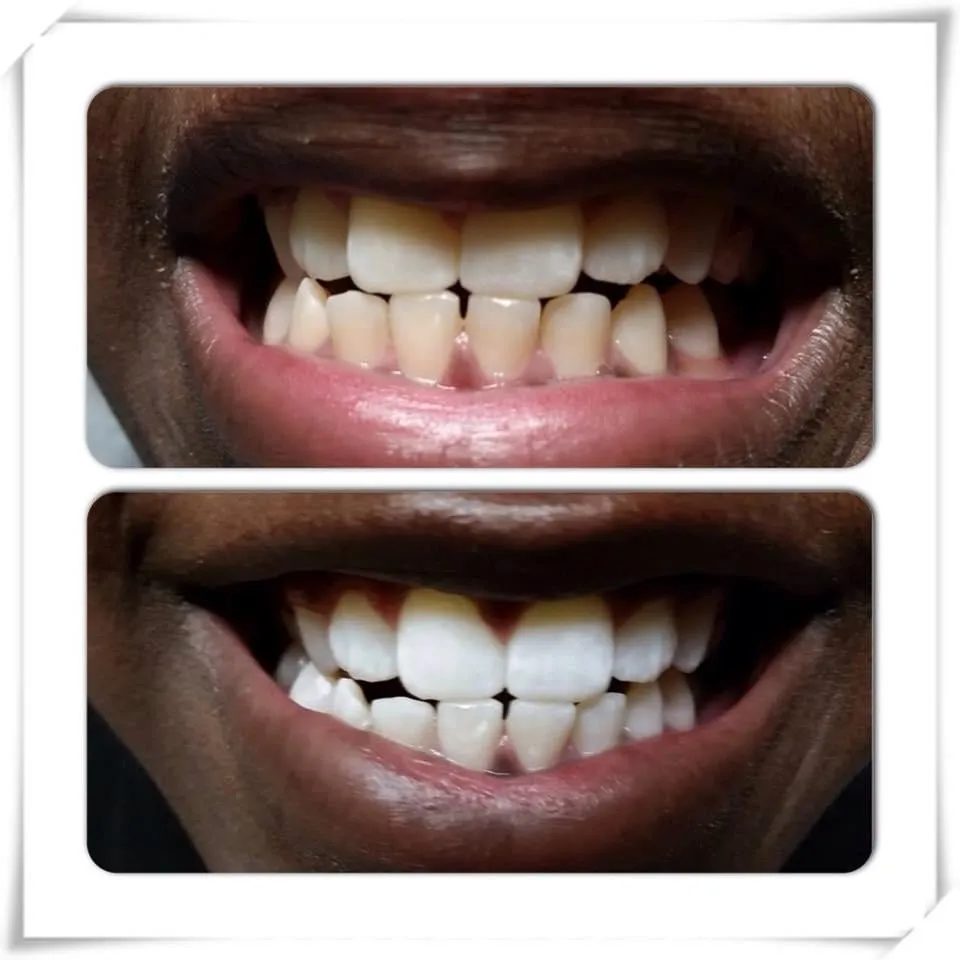 30731 cincinnati teeth whitening before after
