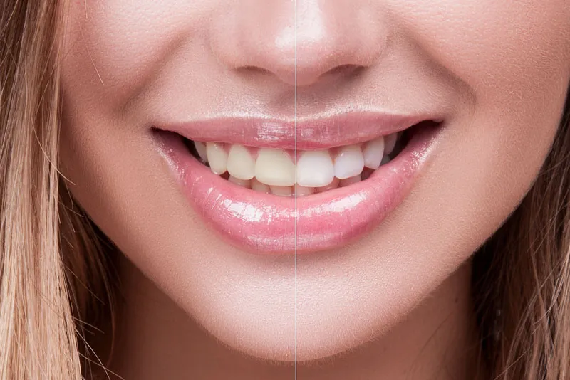 30731 healthy diet teeth whitening