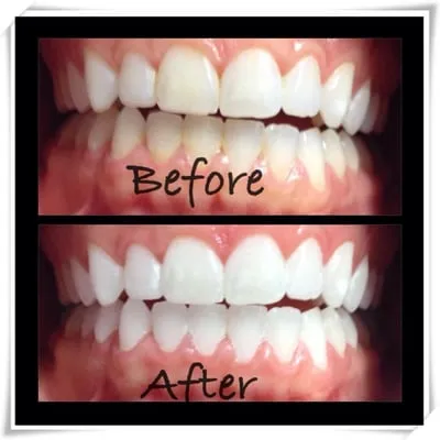 30731 teeth whitening in office