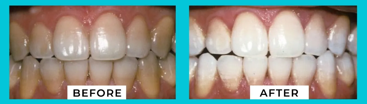 30733 mobile teeth whitening application