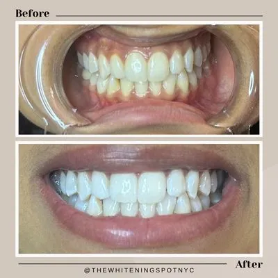 30734 new york whitening kit