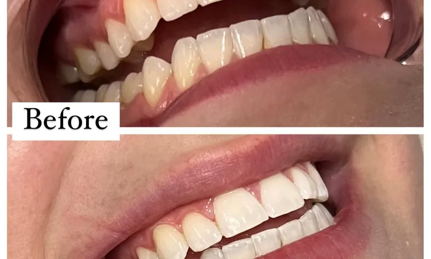 30740 teeth whitening chicago groupon 3