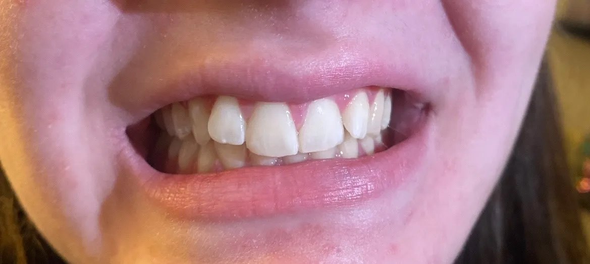 30740 teeth whitening chicago groupon 6