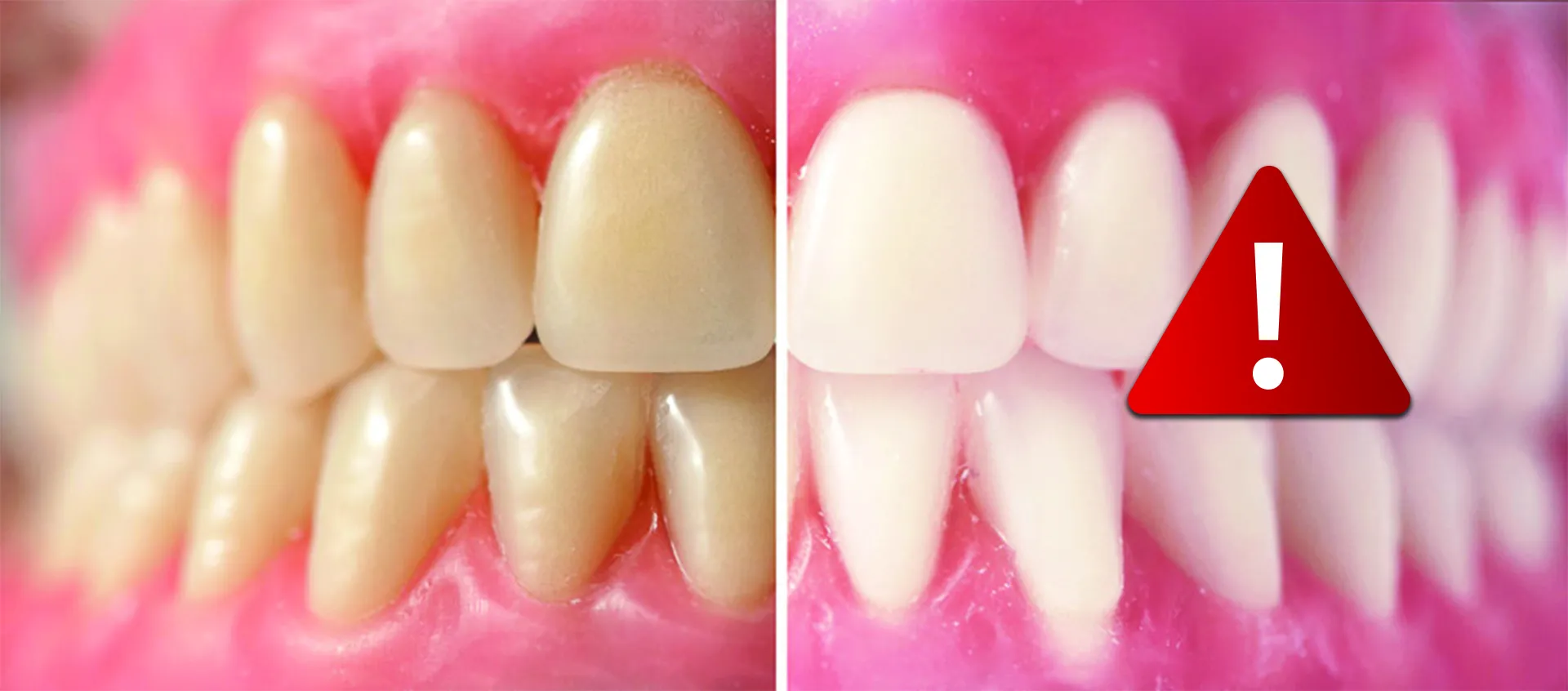 30743 in office teeth whitening