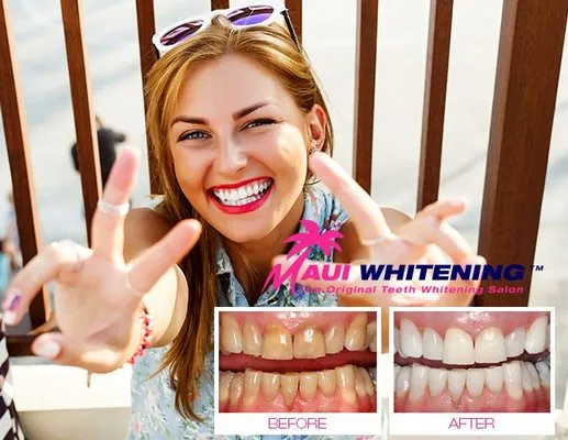 30752 at home teeth whitening kits
