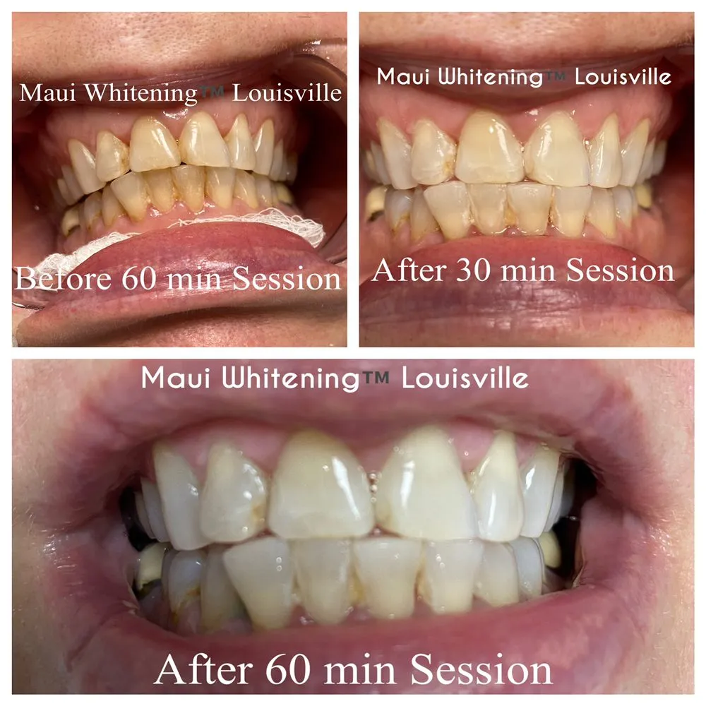 30752 in office teeth whitening procedure
