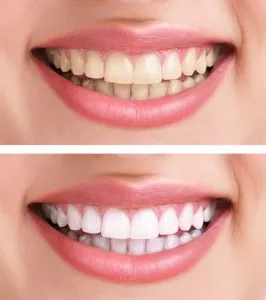 30755 at home teeth whitening