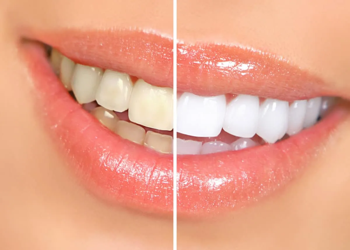 30755 in office teeth whitening