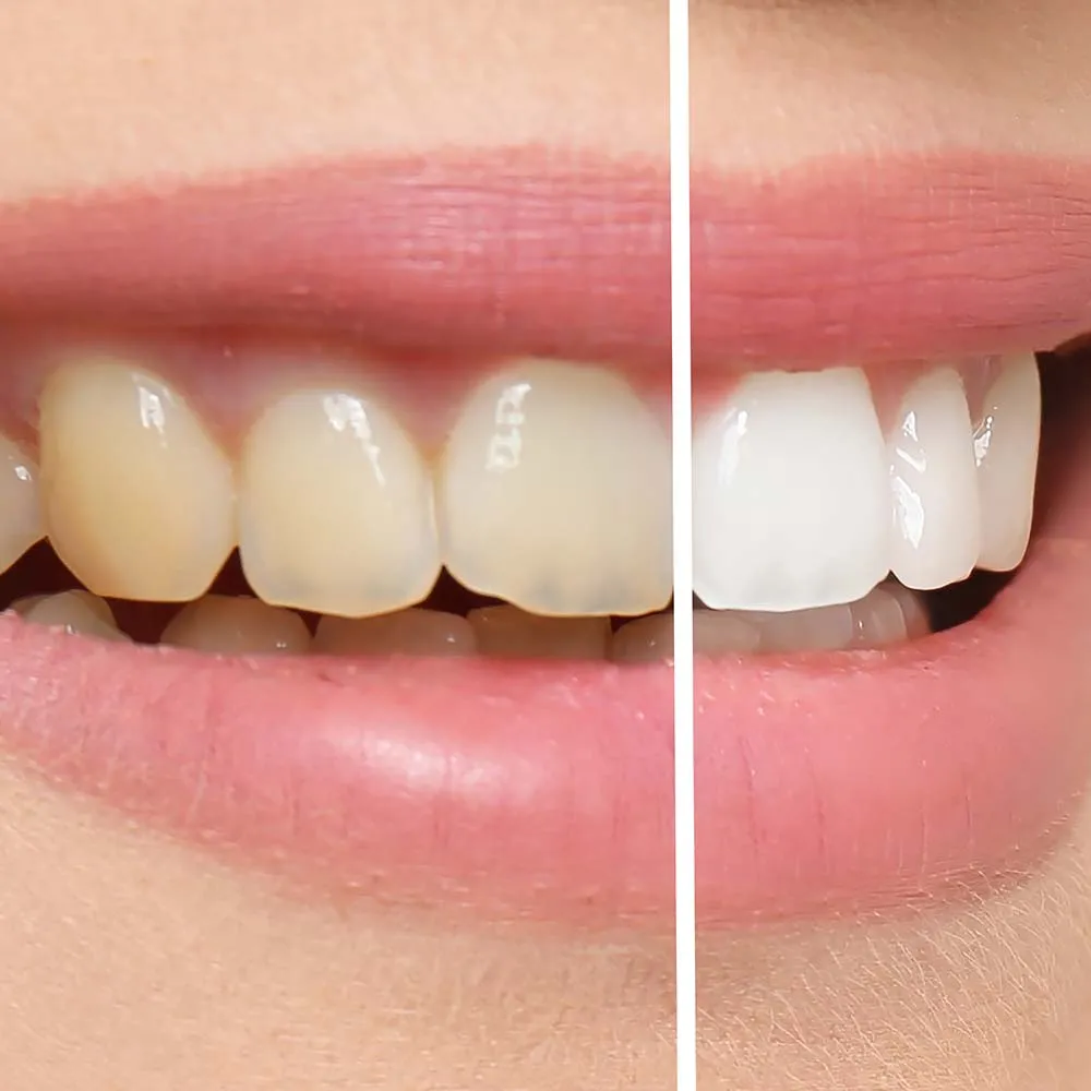 30755 teeth whitening phoenix guide