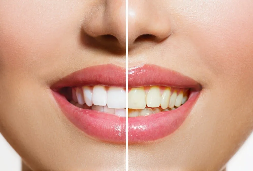 30755 teeth whitening results